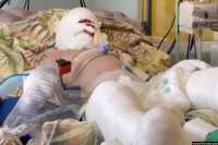 Обгоревший от российского обстрела в Виннице мальчик будет лечиться в Германии