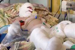 Обгоревший от российского обстрела в Виннице мальчик будет лечиться в Германии